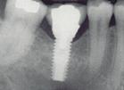 Perfect Smile implant apical radiograph